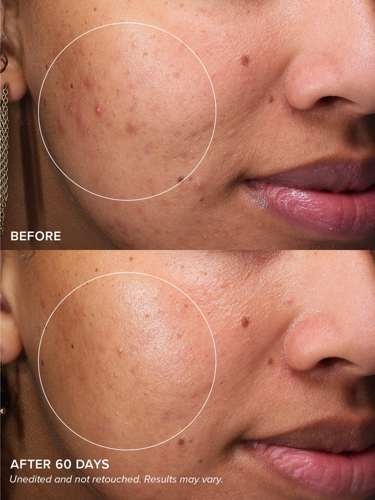 Gentle Acne Serum - Image 4